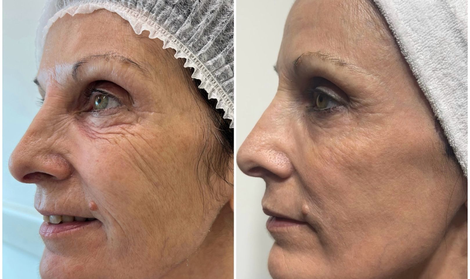 Tratamientos con láser