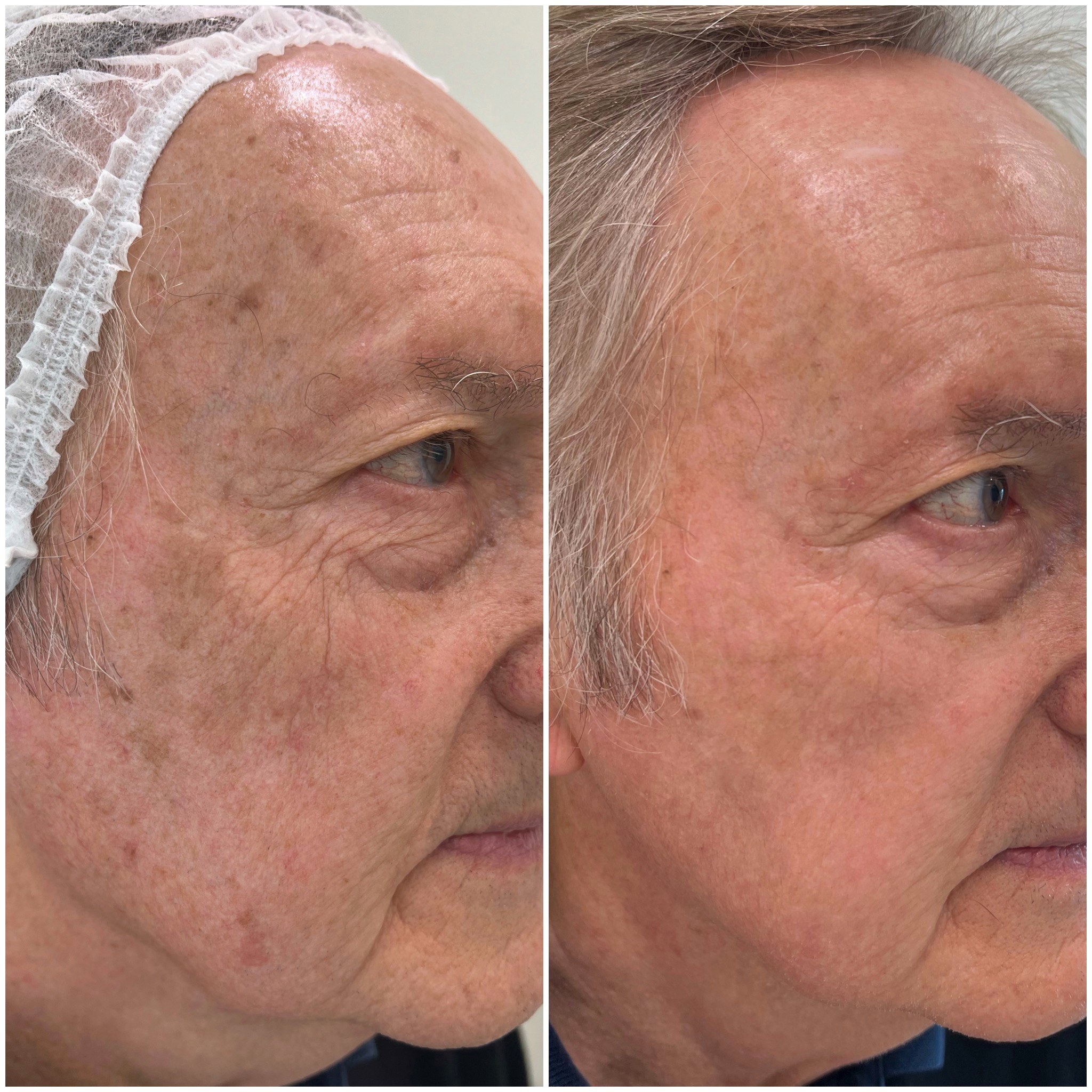 Tratamiento con Luz Pulsada