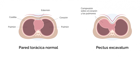 pectus