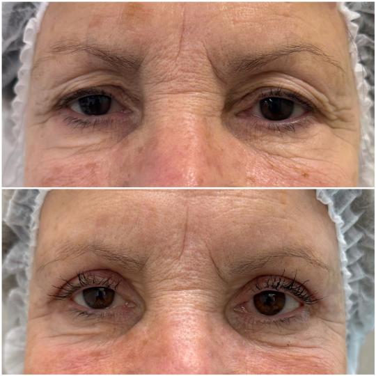 Blefaroplastia láser: una mirada más fresca con un procedimiento preciso y ambulatorio